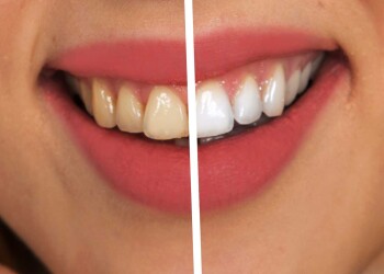 Perfekte Zahnstellung mit weissen Zähnen für ein strahlendes Lachen.